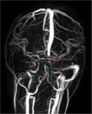 Case Report: Primary catastrophic antiphospholipid syndrome in a pediatric patient with cerebral venous sinus thrombosis as the first manifestation